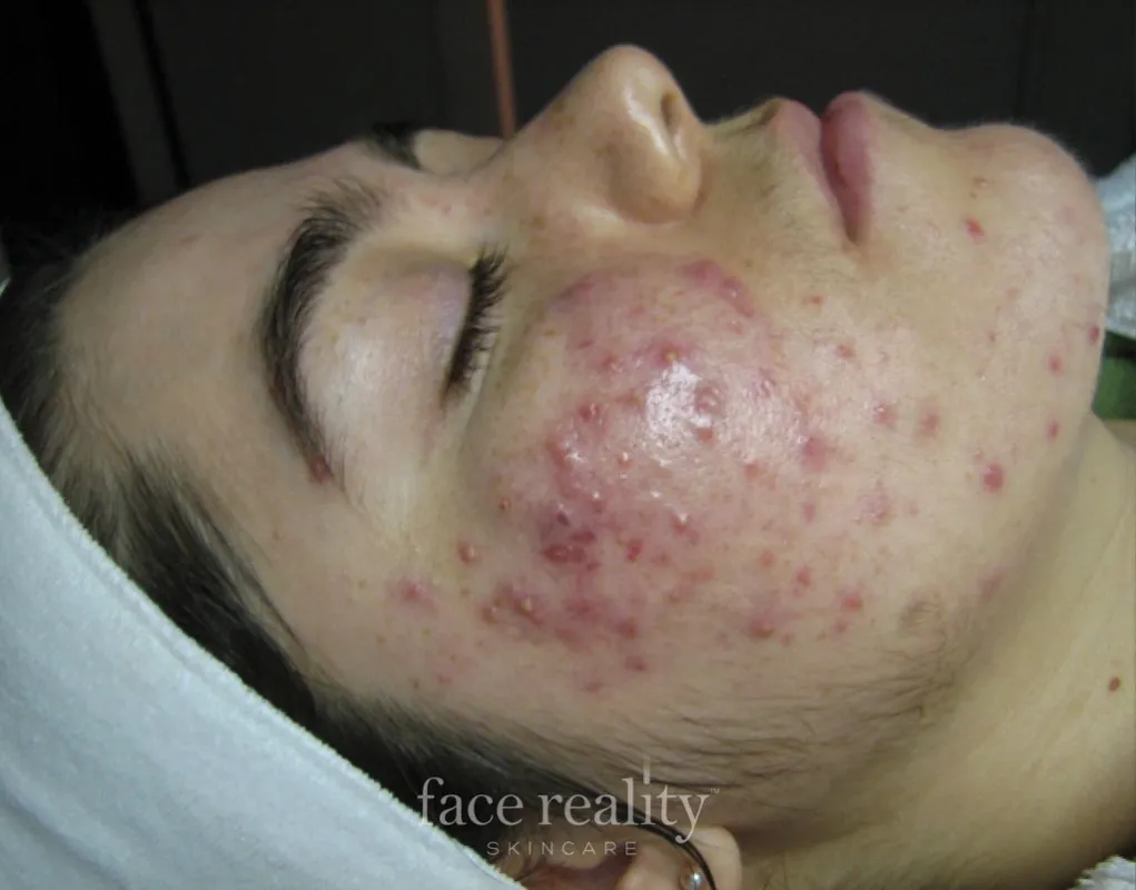 acne program five skin confident spa