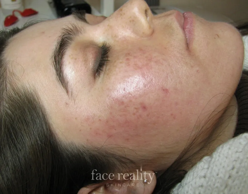 acne program four skin confident spa
