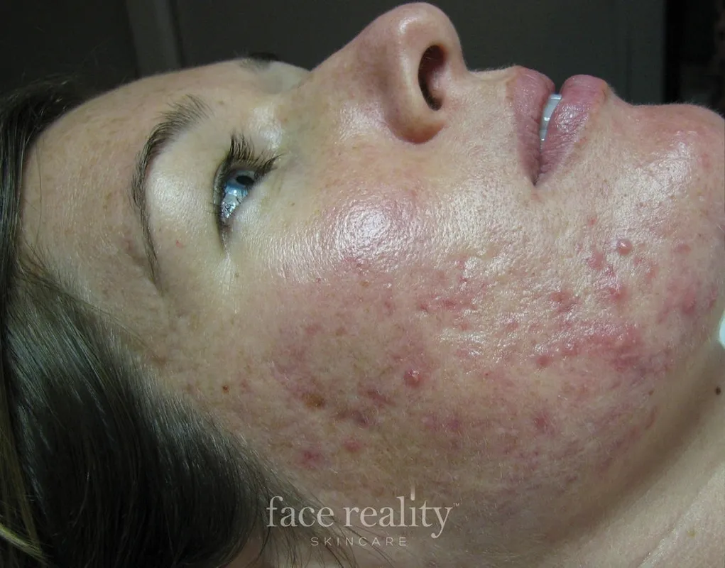 acne program one skin confident spa