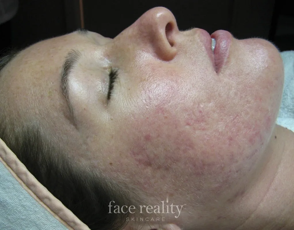 acne program skin confident spa