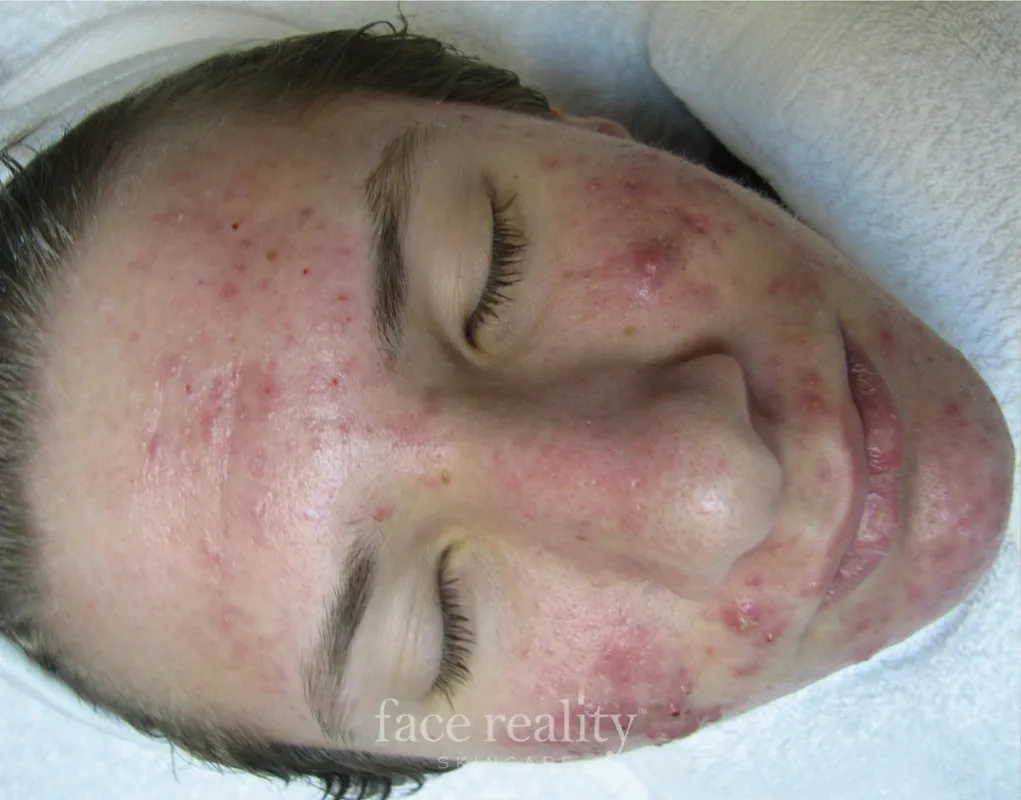 acne program three skin confident spa