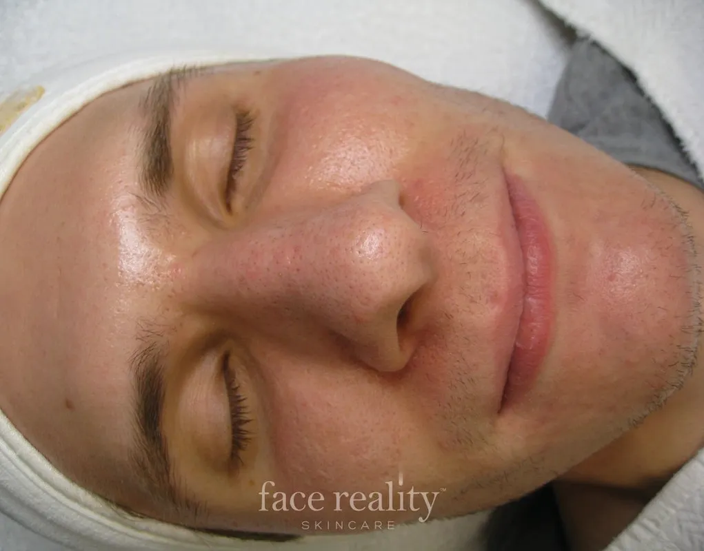 acne program two skin confident spa